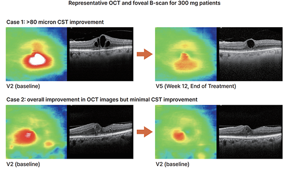 Ph2a results of Rivasterat